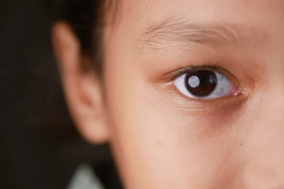 Exploring Visual Processing Disorder VPD 1